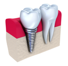 Implantes dentales Teruel