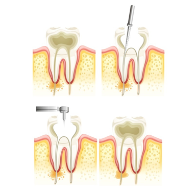 Endodoncia Teruel