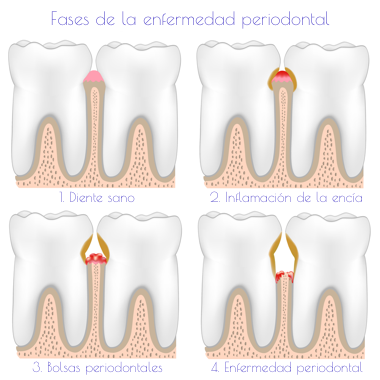 Periodoncia Teruel