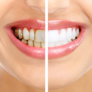 Blanqueamiento dental Teruel